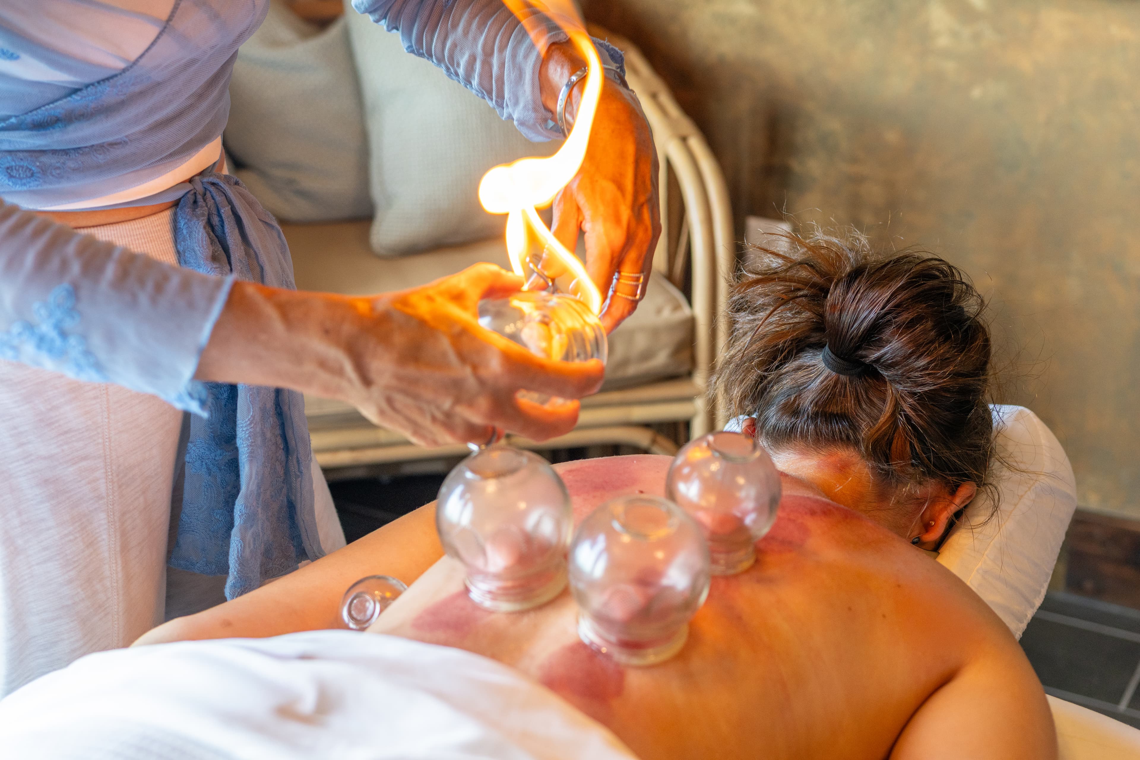 A person receives cupping therapy as a practitioner prepares suction cups on their back.